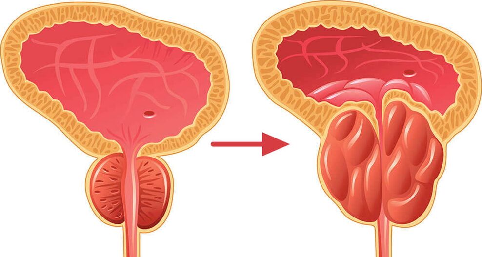 Prostate gland - normal and inflamed