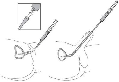 Intensity of drug solution in the urethra