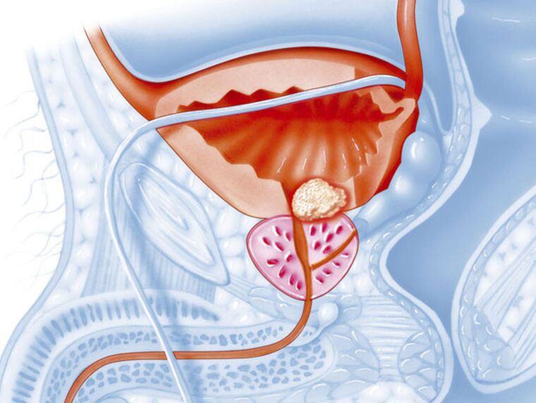 In chronic prostatitis, the lumen of the urethra narrows, making it difficult for urine to flow out. 