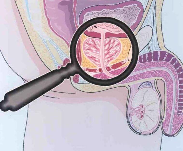 The defeat of the prostate tissue in patients with chronic prostatitis men